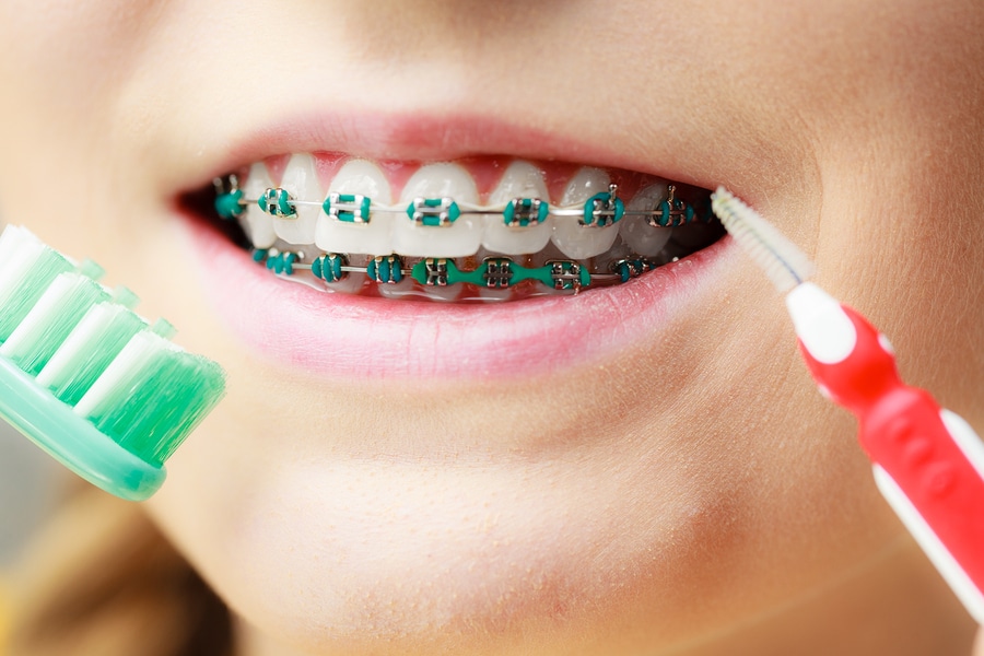 Caring For Your Teeth With Braces Centralia Orthodontics