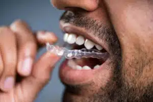 Reasons to Choose Invisalign: Proven Benefits You Can Trust