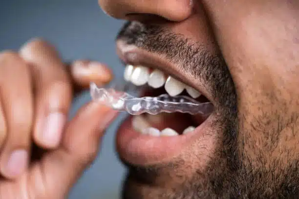 Invisalign treatment length