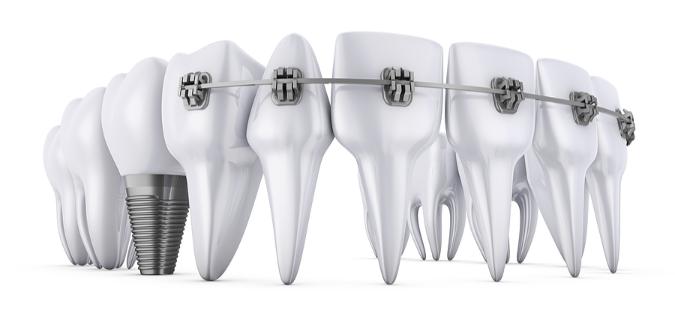 Straighten Teeth with Braces After Implants: Factors & Tips