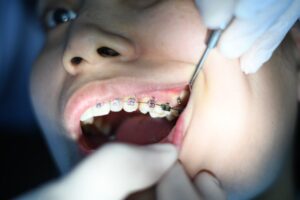 Straighten Teeth with Braces After Implants: Factors & Tips