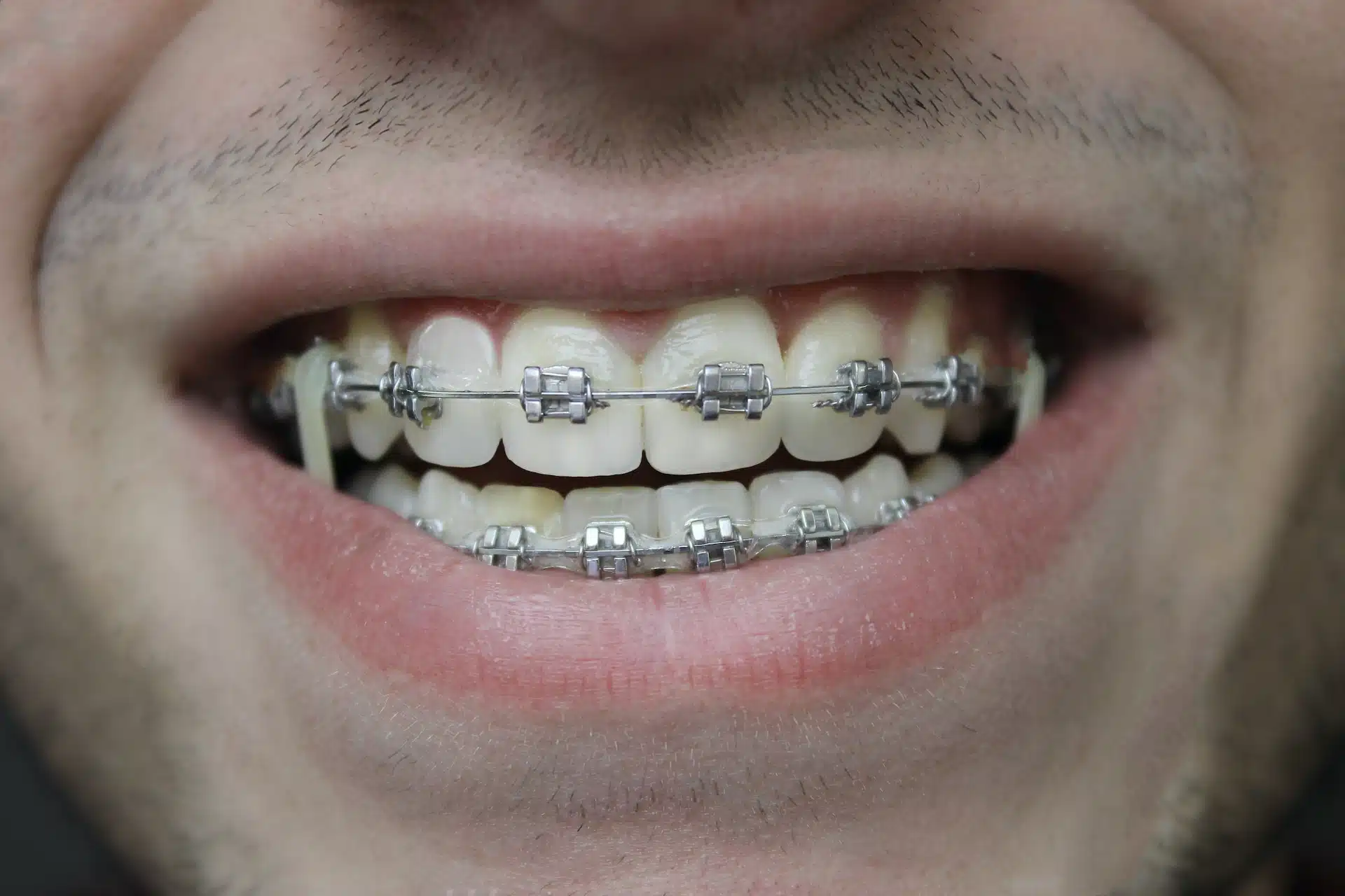 Truth About Dental Braces: Expert Insights for a Healthier Smile